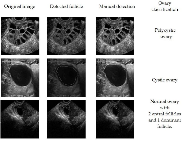 pcos-follicles